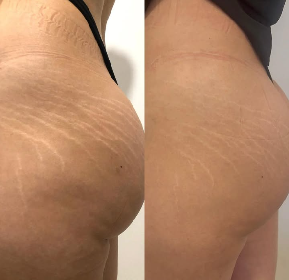 Nue Conceal Consultation