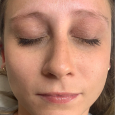 Cosmetic Tattooing-before